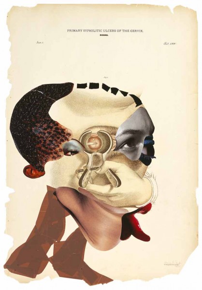 wangechi_mutu_primarysyphiliticulcersofthecervix2005